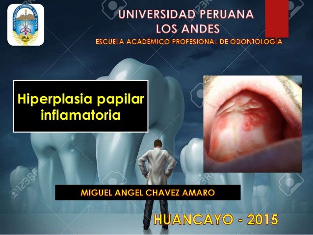 hiperplasia papilar inflamatoria